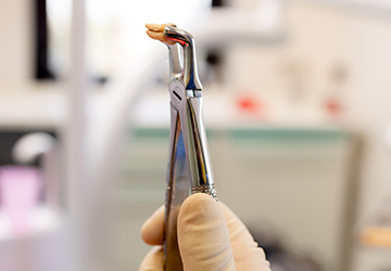 MallDental-chirurgie-dento-alveolara 1